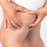 Lipedema também pode atingir homens; doença é confundida com sobrepeso