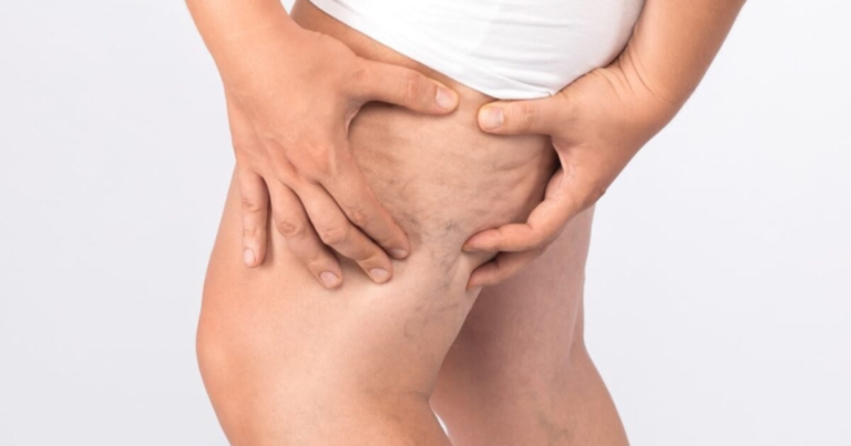 Lipedema também pode atingir homens; doença é confundida com sobrepeso